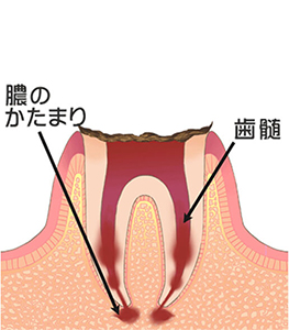むし歯の進行段階
